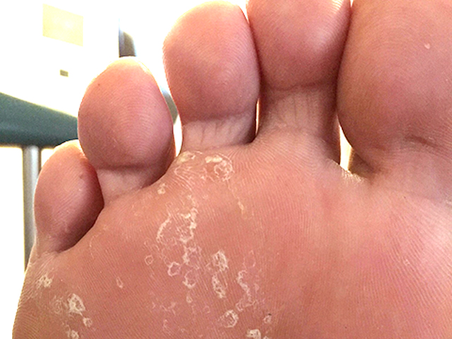 足白癬