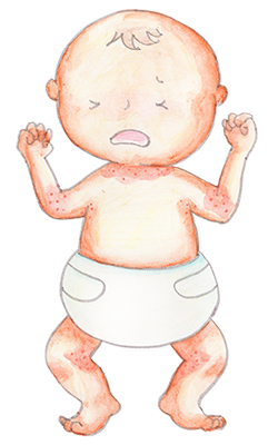 アトピー乳児
