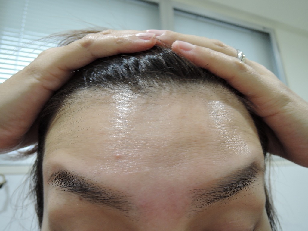 前額部アフター