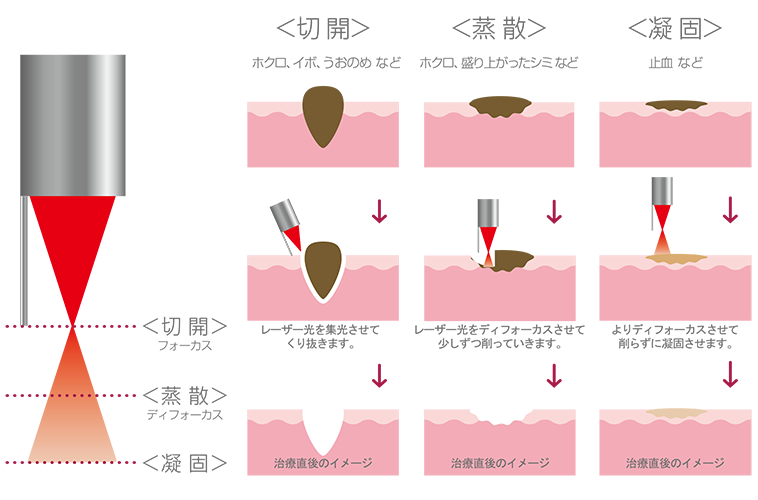 炭酸ガスレーザー