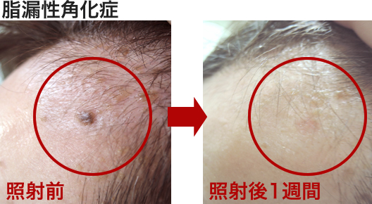 脂漏性角化症